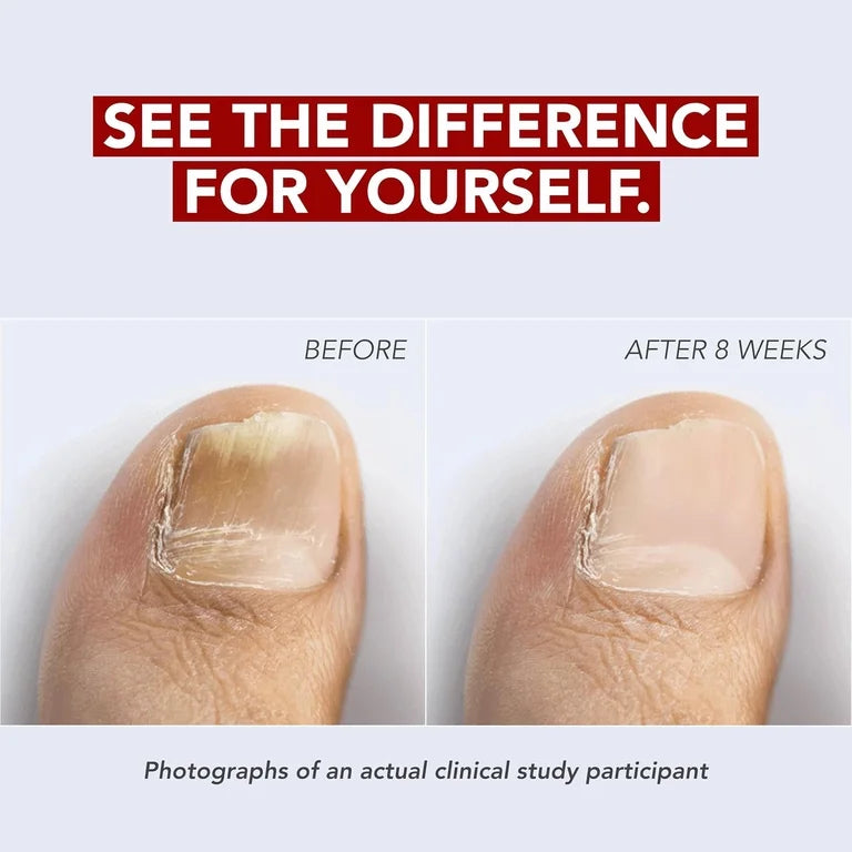 Kerasal Fungal Nail Renewal 10 ml