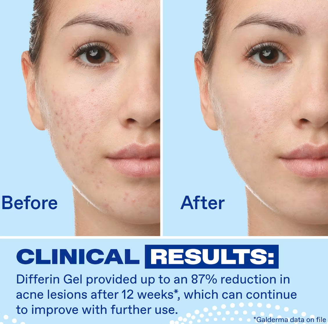 Differin Adapalene Gel 0.1% Acne
Treatment Fragrance Free 15 g