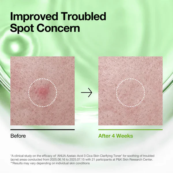 Anua Azelic acid soothing & brightening, full sized 3 products set